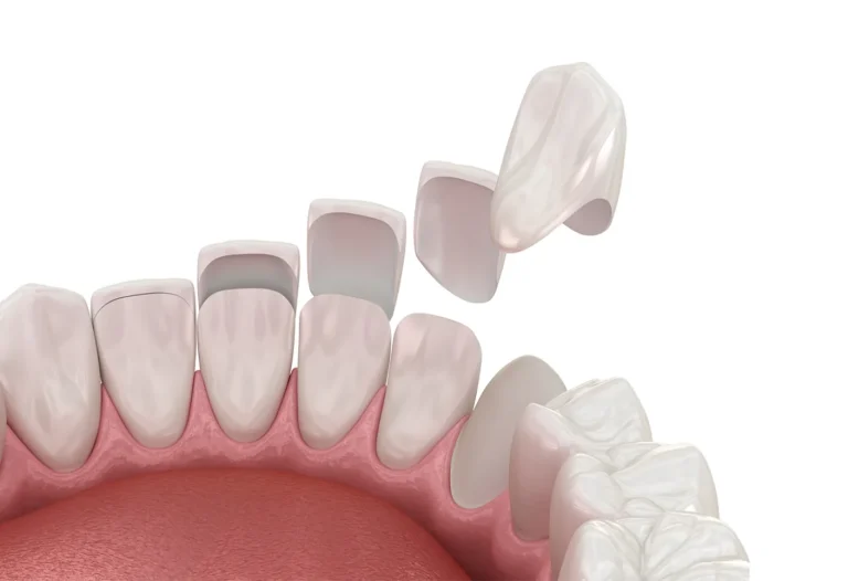 Diastema Closure
