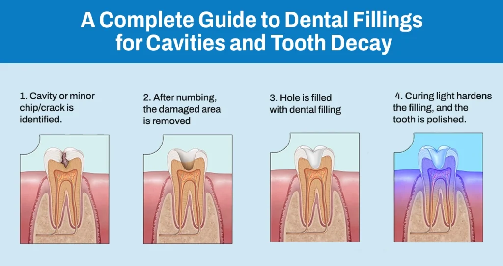 A Complete Guide to Dental Fillings for Cavities and Tooth Decay