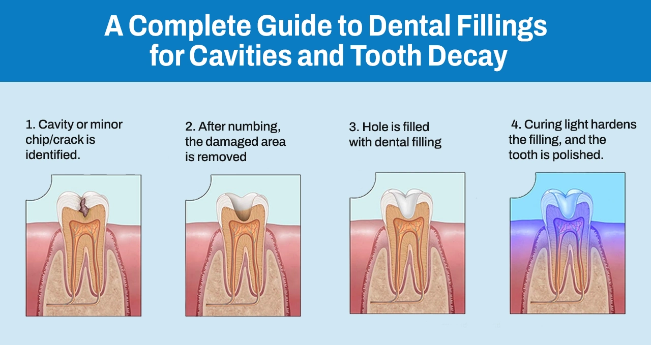 A Complete Guide to Dental Fillings for Cavities and Tooth Decay– Dr ...