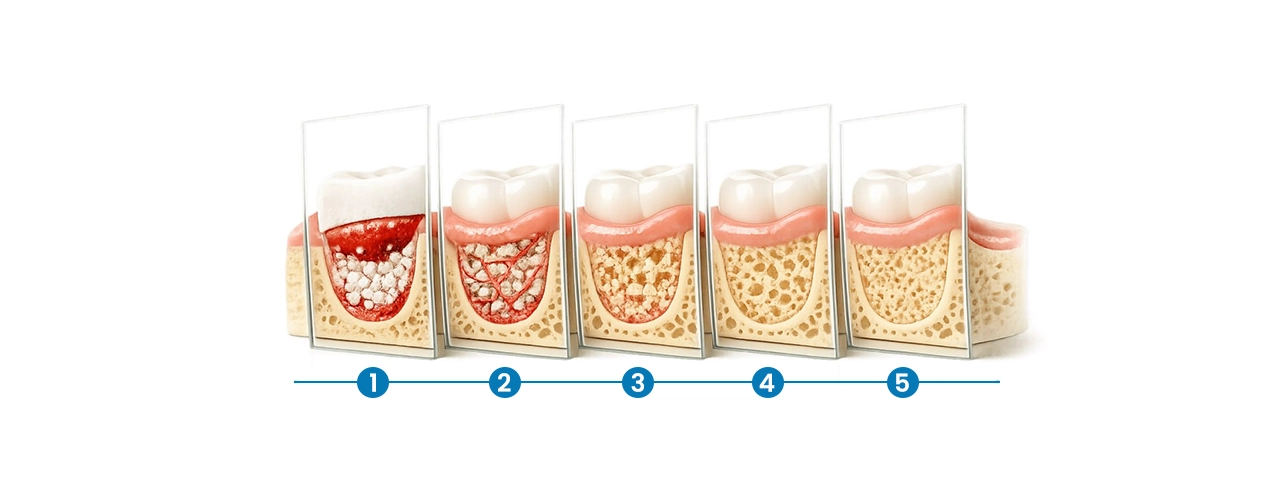 Bone Grafting for Dental Implants