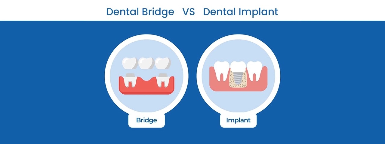 dental implant vs dental graft