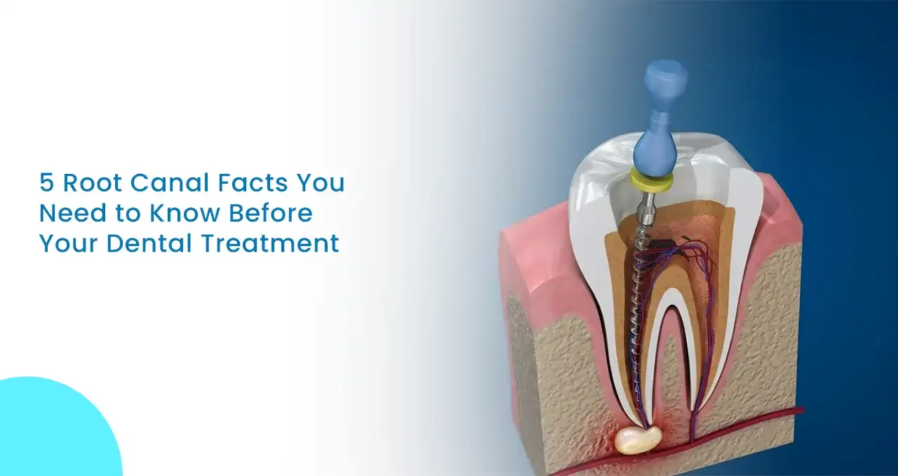 5 Root Canal Facts You Need to Know