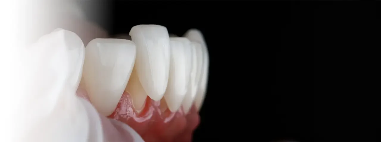 Advantages of Porcelain Veneers for Oral Health and Aesthetics