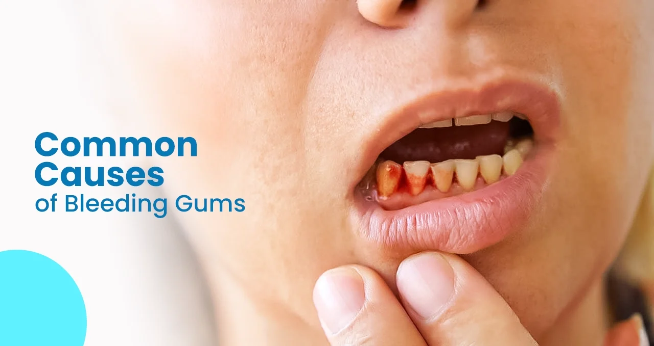 gums bleeding