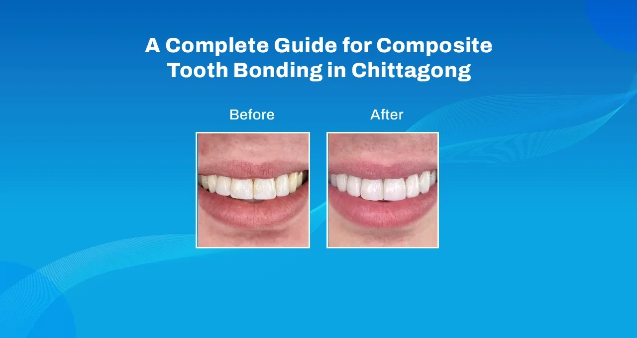 Composite Tooth Bonding in Chittagong