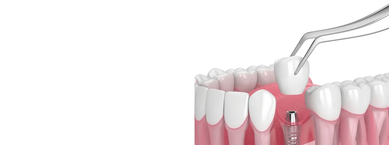 Dental Implant