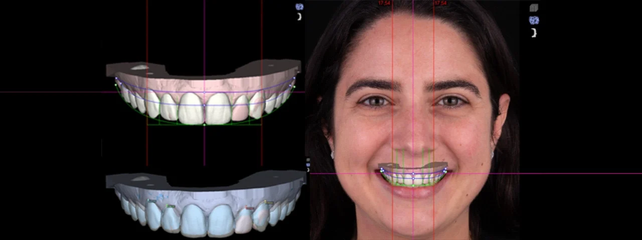 How Does the Digital Smile Design Workflow Work