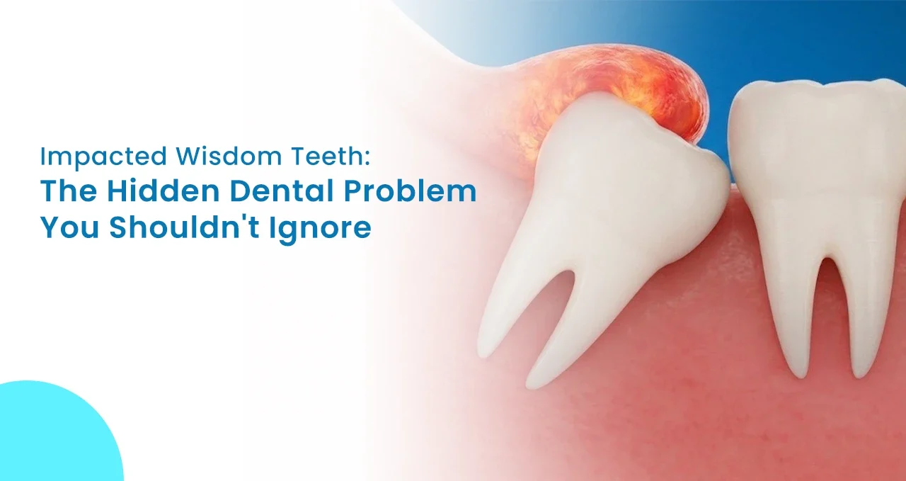 Impacted Wisdom Teeth The Hidden Dental Problem You Shouldn't Ignore