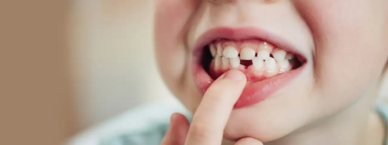 Loss of Baby Teeth is Not a Problem