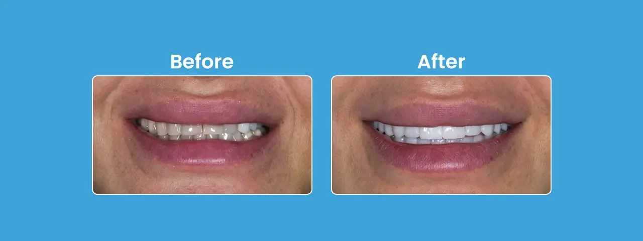 Porcelain Veneers