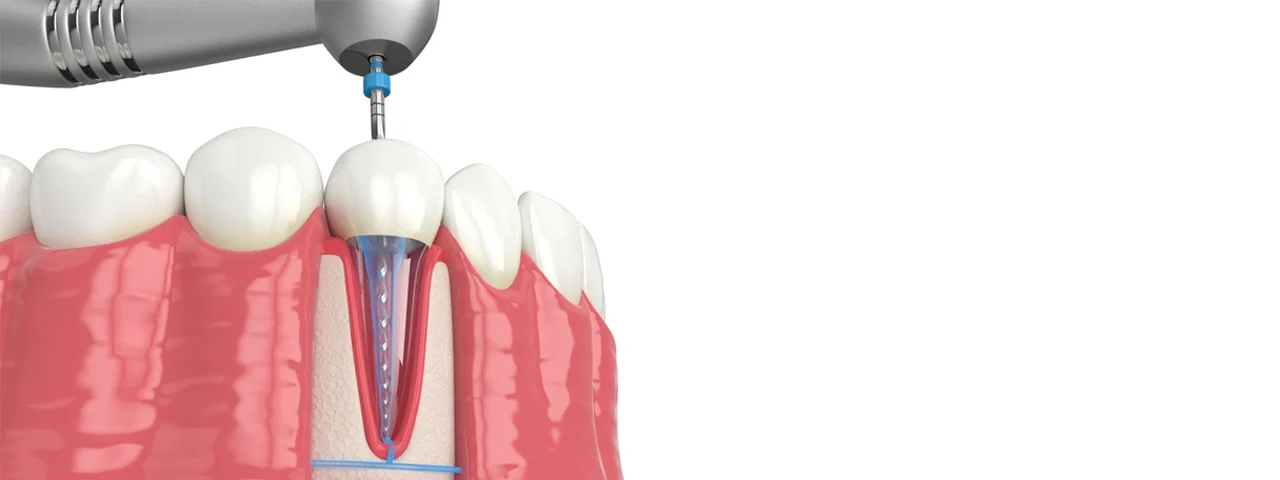 Root canal