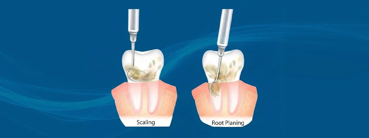 Scaling and Root Planing for Gum Disease Treatment