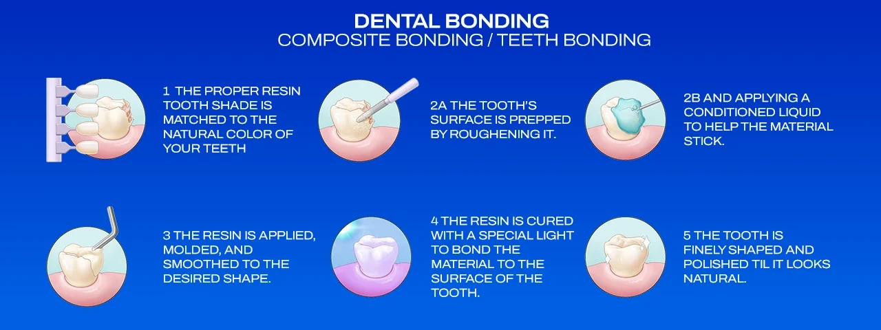 The Procedure of Composite Bonding