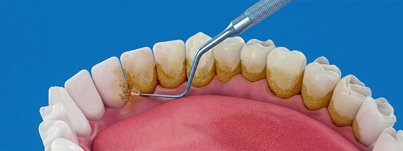What is Tooth Scaling and Why is Dental Scaling Needed