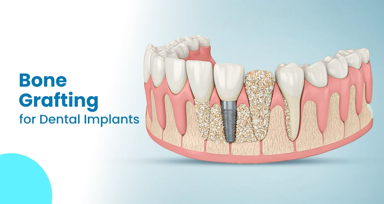 Bone Grafting for Dental Implants