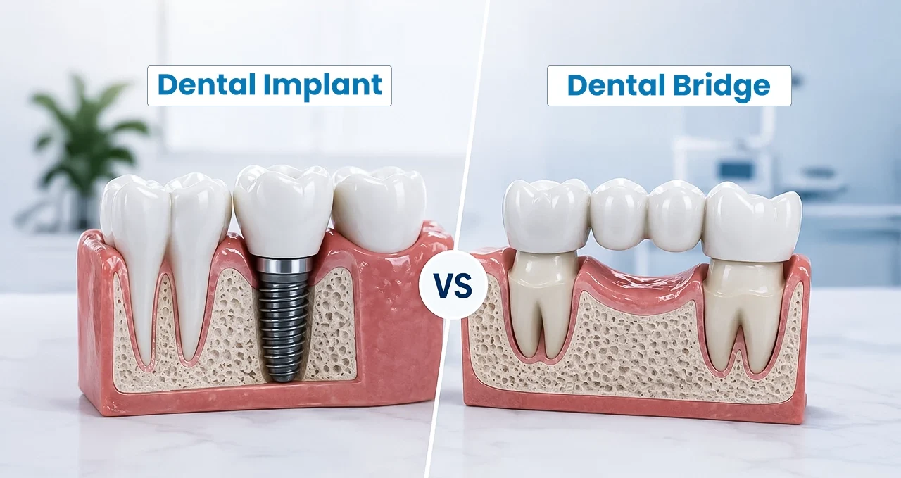 Dental Implant vs Dental Bridge